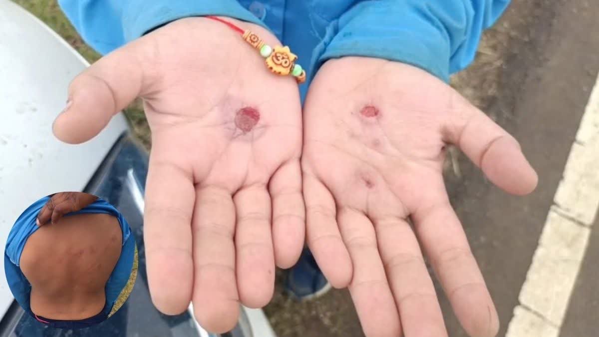 आधी रात को बेल्ट से पीटा फिर दागे हाथ; मंडला छात्रावास की खौफनाक घटना से फूटा ग्रामीणों का गुस्सा