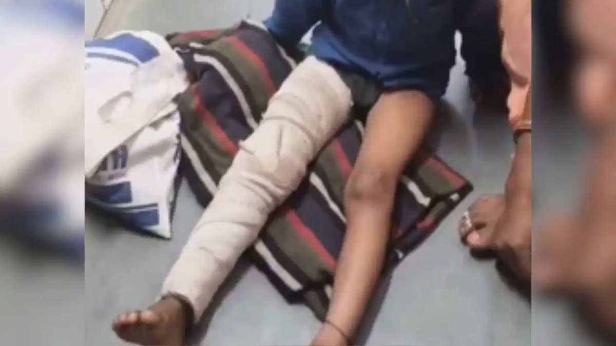 छतरपुर में मासूम छात्र से मारपीट: बैग न लाने पर शिक्षक ने पैर तोड़ा, FIR दर्ज