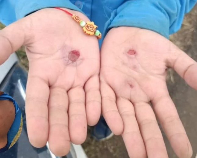 आधी रात को बेल्ट से पीटा फिर दागे हाथ; मंडला छात्रावास की खौफनाक घटना से फूटा ग्रामीणों का गुस्सा