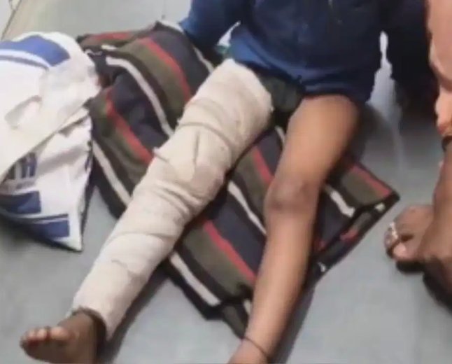 छतरपुर में मासूम छात्र से मारपीट: बैग न लाने पर शिक्षक ने पैर तोड़ा, FIR दर्ज